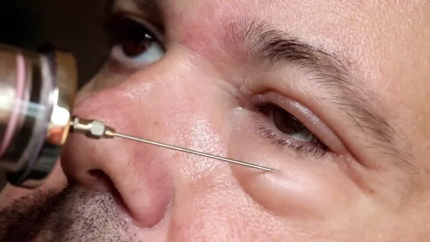 Is Under Eye Injection a Possibility with Dermal Fillers?